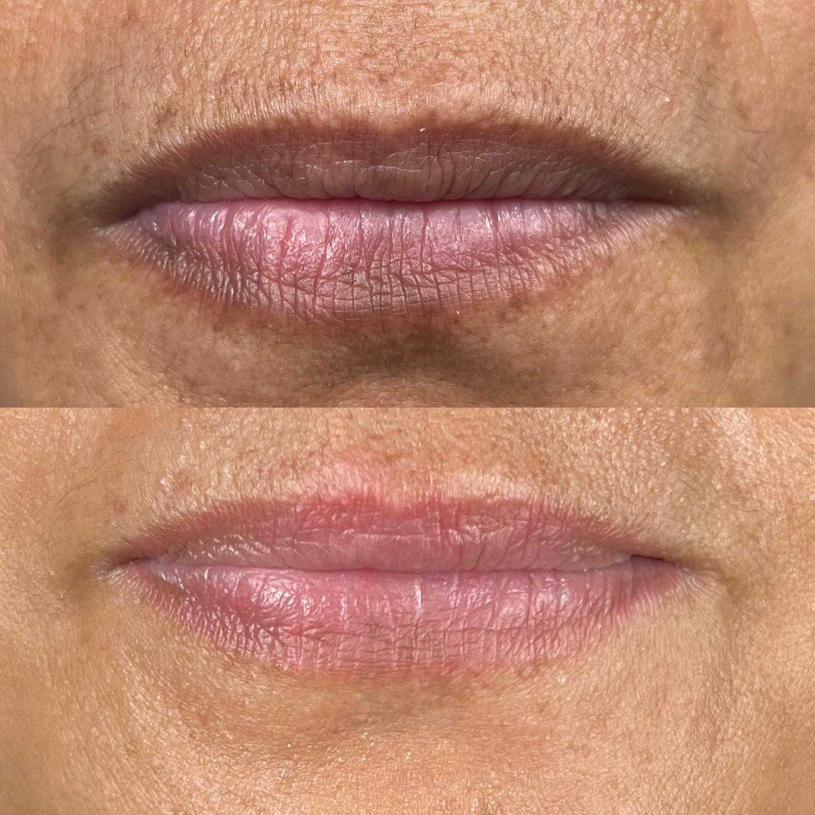 Semi-permanent makeup — dark lip neutralisation — Before and after dark lip neutralisation.