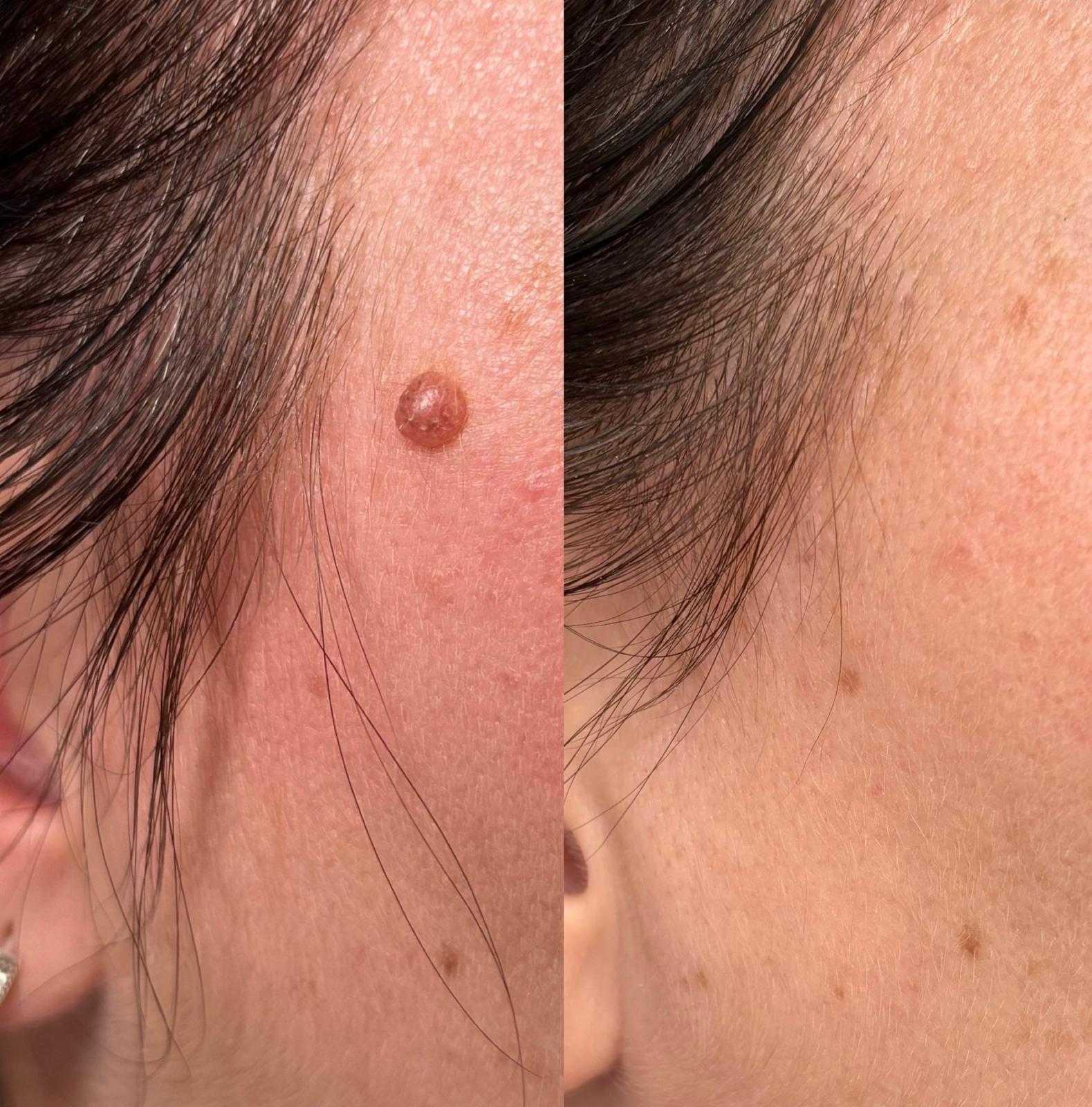 Plasma pen — mole removal — Before and after plasma pen mole removal.