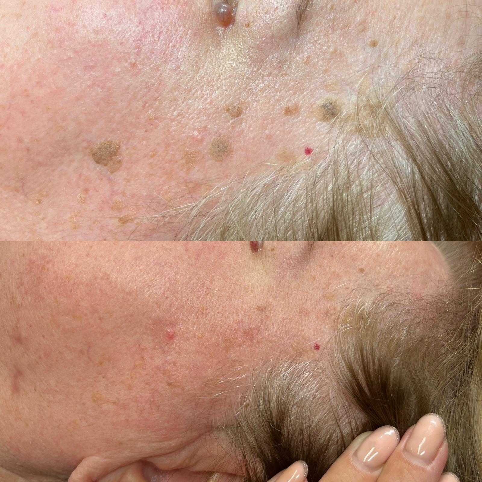 Plasma pen — seborrheic keratosis removal — Before and after seborrheic keratosis removal.