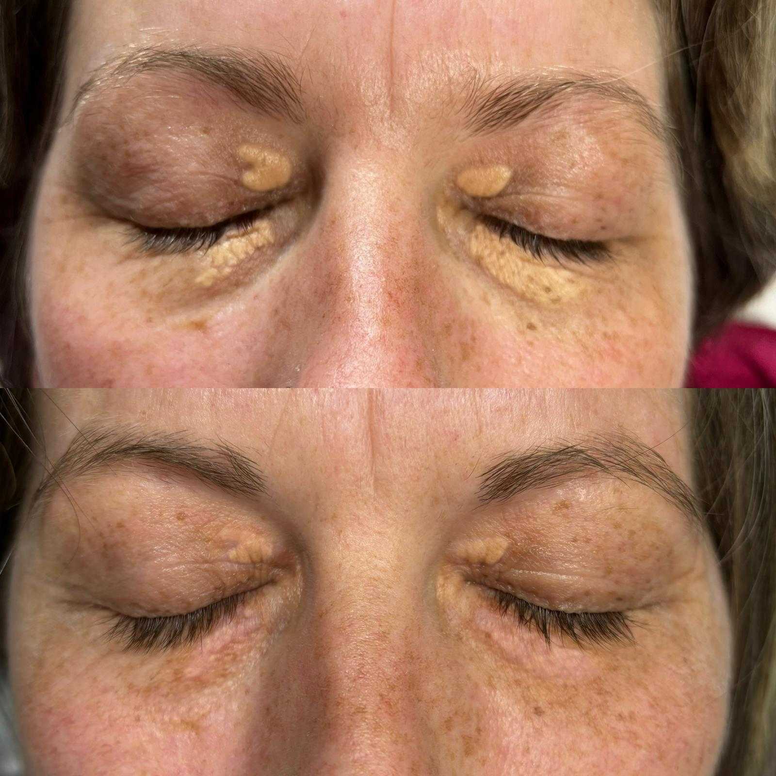 Plasma pen — xanthelasma removal — Before and after one session of xanthelasma removal.